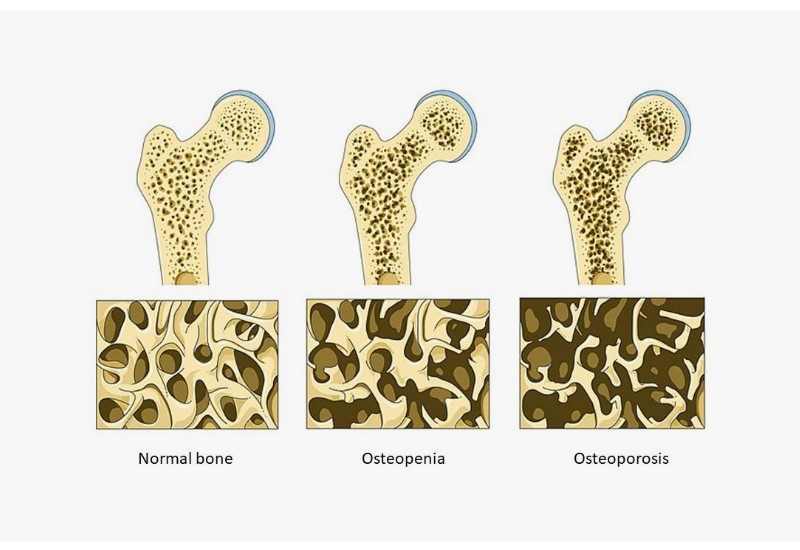 What is Osteoporosis